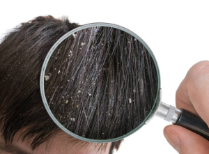 Read more about the article Dandruff Causes, Symptoms, and 5 Treatment Options