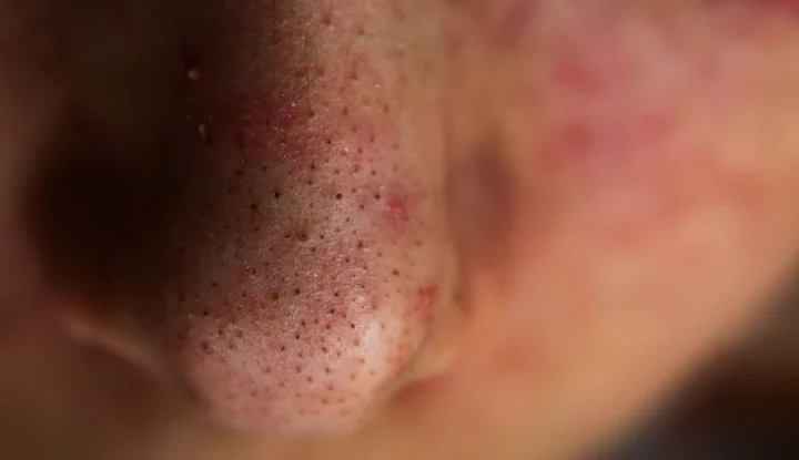 22038 blackheads 22038 blackheads