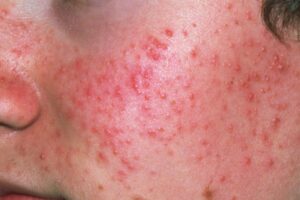 Read more about the article ACNE: Causes, Types, and Effective 6 Treatment Strategies