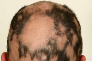 Read more about the article Alopecia: Comprehensive Understanding of the Causes, Symptoms, and 5 Treatment Options for Alopecia