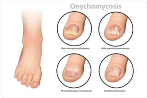 Read more about the article Onychomycosis: Nail Fungal Infection Onychomycosis causes and How to Prevent It