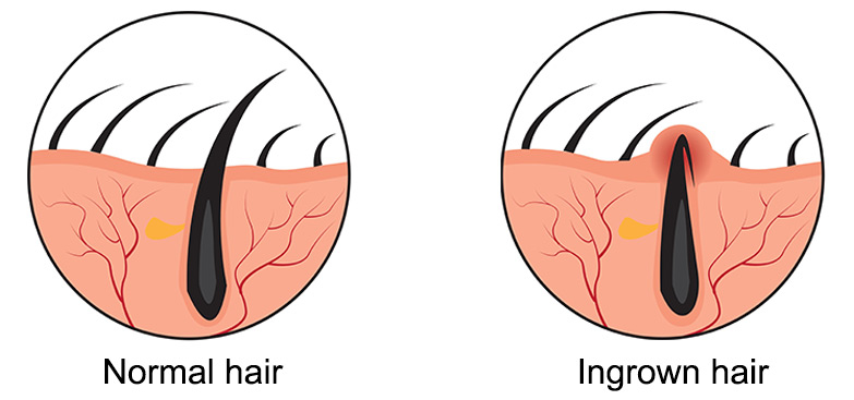 ingrown hair illustration e7f23a ingrown hair illustration e7f23a