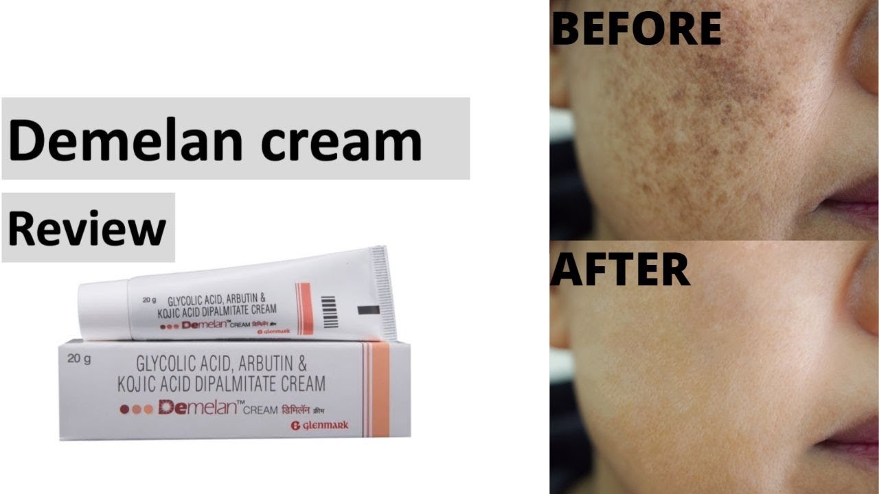 Read more about the article Demelan Cream : Does it effectively treat skin hyperpigmentation?