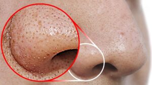 Read more about the article Blackheads: Effective Products and Tips for Clearer, Smoother Skin